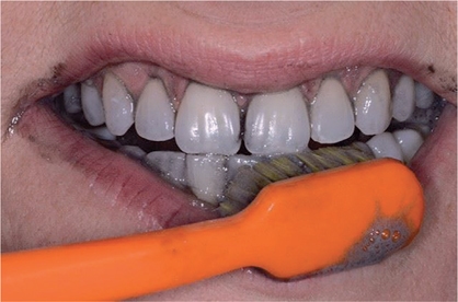 Witte tanden: of fictie? -